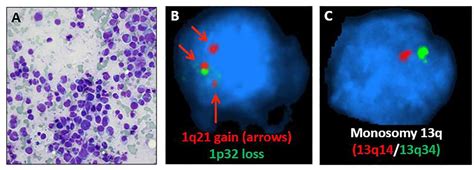 Aggressive Presentation Of Plasmablastic Myeloma Bmj Case Reports