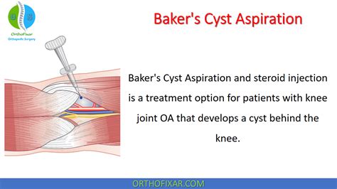 Baker S Cyst Aspiration OrthoFixar 2025