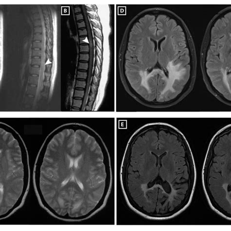 | Spinal cord and brain MRI of the patient. In 2003, MRI of the spinal ...