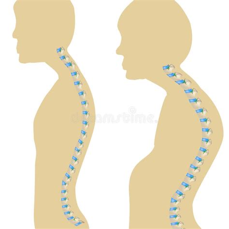 Ejemplo Del Vector De La Cifosis Diagnosis Trasera Del Defecto De La