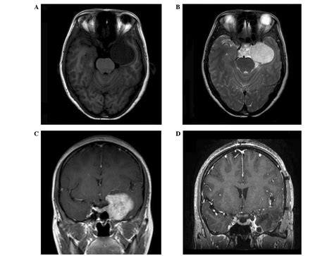 Gamma Knife Radiosurgery For The Treatment Of Cavernous Sinus Hemangiomas