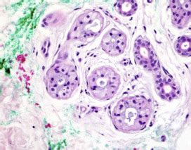 Aquagenic Palmoplantar Keratoderma With Dorsal Hand Involvement In An