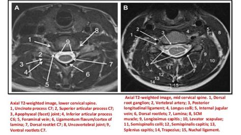 MRI SPINE ANATOMY