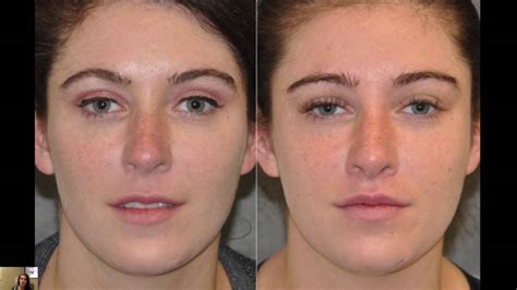 Best Upper Lip Lift Surgeon Beverly Hills Modified Upper Lip Lift Best