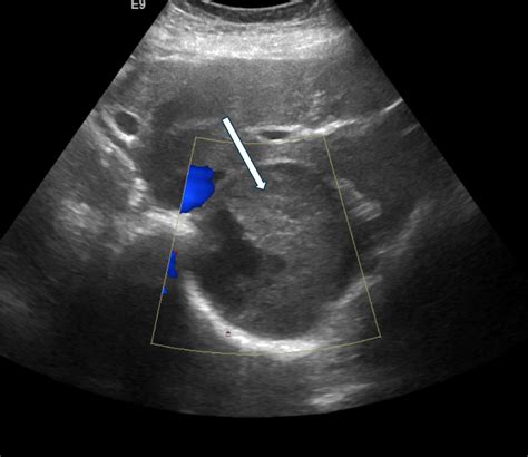 Adrenal Haematoma Versus Liver Cyst Discrimination By Contrast