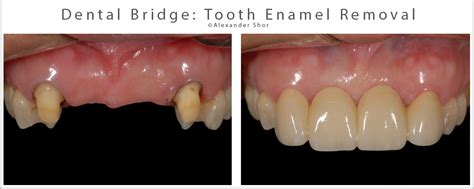 Resin Bonded Bridge: Minimally Invasive Option for Tooth Replacement ...