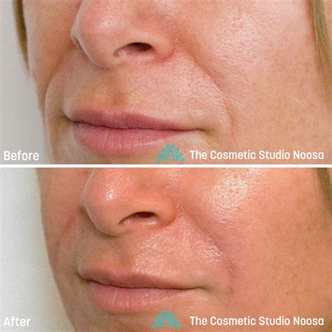 Nasolabial Fold Filler The Cosmetic Studio Noosa