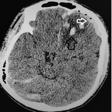 Non Contrast Ct Head Axial View Demonstrates Biconvex Acute Epidural