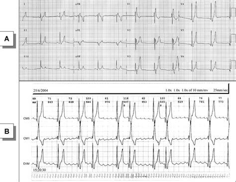 Electrocardiographic Recordings In A 27 Year Old Male With Short Qt