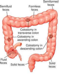 Colostomy – Ostomy India