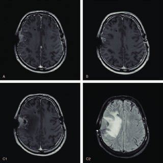 Axial Post Contrast T Weighted Magnetic Resonance Imaging Showing