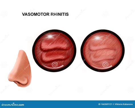 Illustration Of Vasomotor Rhinitis Of The Nasal Mucosa Healthy And