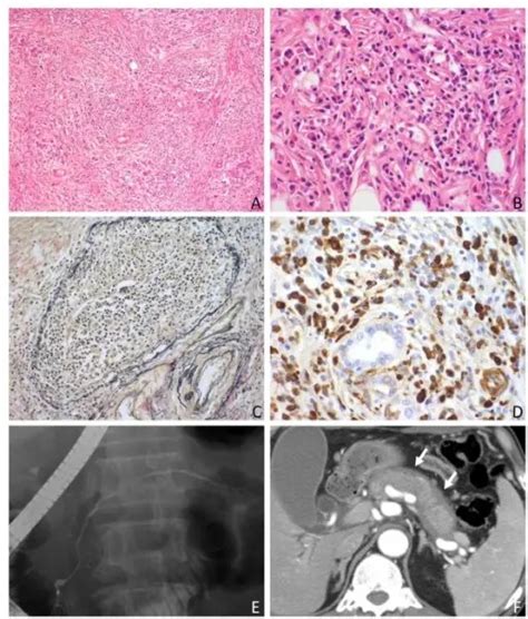 What Is Sclerosing Retroperitoneal Fibrosis Pathosomes