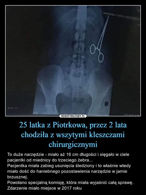 25 latka z Piotrkowa przez 2 lata chodziła z wszytymi kleszczami