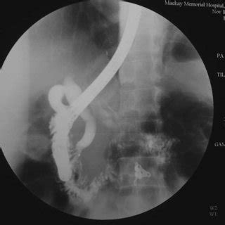 Endoscopic Retrograde Cholangiography With Injection Of Contrast Agent