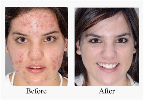 Castor Oil Before And After Skin Hd Png Download Kindpng