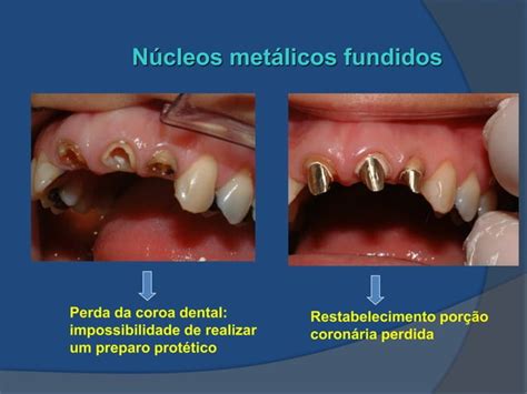 O Metal Presente Nos Ossos E Nos Dentes - Aula Nucleo metalico fundido para dentes tratados endodonticamente | PDF