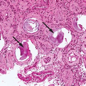 Recommendations For Management Of Testicular Microlithiasis