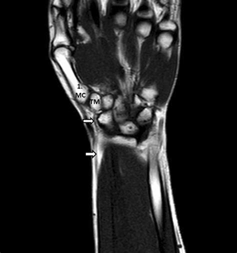 Coronal T1W TSE MR Image Of The Wrist M Flexor Carpi Radialis Tendon