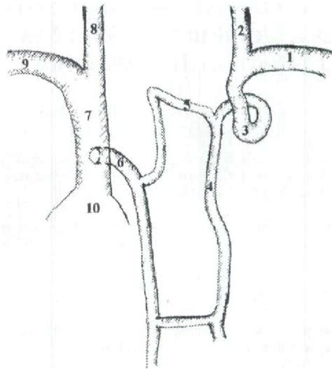 Anatomical Representation Of Absent Left Brachiocephalic Vein 1 Left Download Scientific