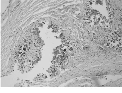 Figure From Tumoral Calcinosis Of The Foot Mri Histologic