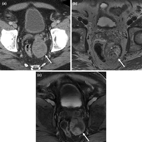 Cystadenoma Of Seminal Vesicle A Axial Contrast Enhanced Ct Through