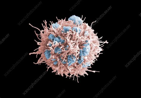 Cervical Cancer Cell SEM Stock Image C059 7494 Science Photo Library