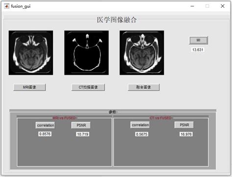 基于matlab医学图像融合gui界面 索炜达猿创