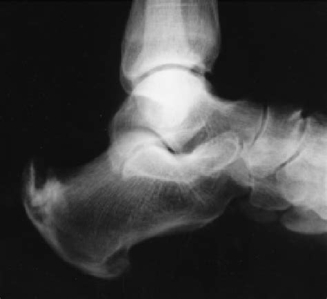 Figure 1 from Massive Calcaneal Enthesopathy in a Non-Healing Leg Ulcer ...