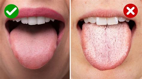 Iron Deficiency Anemia Tongue