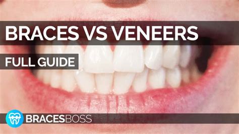 Braces vs Veneers - Full Pro Guide 2022 - BracesBoss