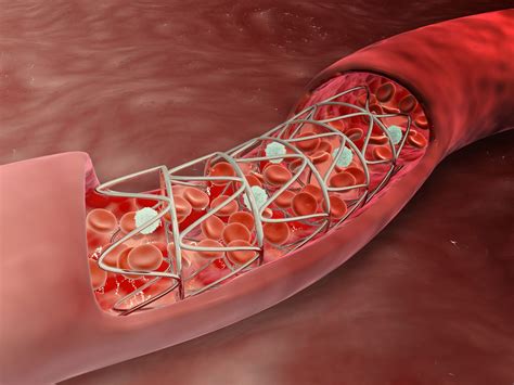 Riesgo de Trombosis Intrastent a lo Largo del Tiempo según Presentación