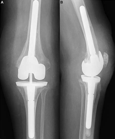 Clinical Outcomes Following The Use Of Constrained Condylar Knees In