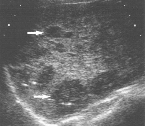 Hepatic Epithelioid Hemangioendothelioma Sonographic Ct And Mr