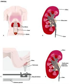 Lithotripsy Surgery India Surgery,Lithotripsy India,Cost Lithotripsy