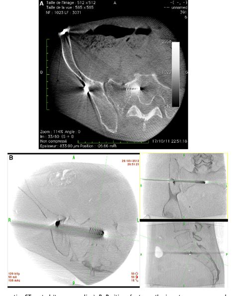 Figure From Percutaneous Iliosacral Screw Fixation In Unstable Pelvic