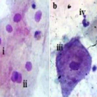 sampled HSIL study group smear cytomorphology. HSIL smear displaying ...