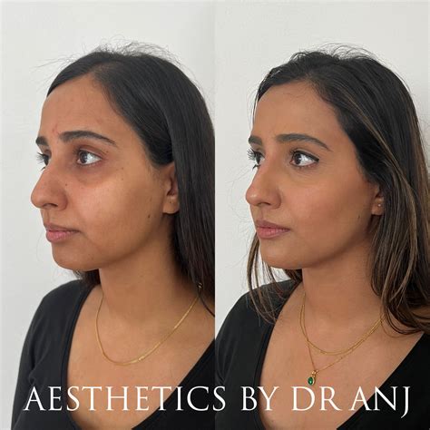 Non Surgical Rhinoplasty — Aesthetics By Dr Anj