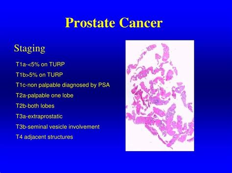 Current Diagnosis And Management Of Prostate Cancer