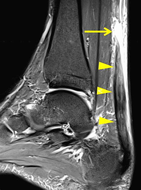 Achilles Tendon Tear | Radsource
