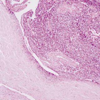 (PDF) Pleuropulmonary Blastoma in a Young Adult Presenting as a ...