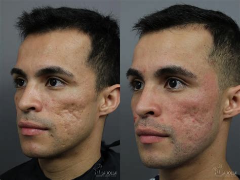 Acne Scars Before After Gallery