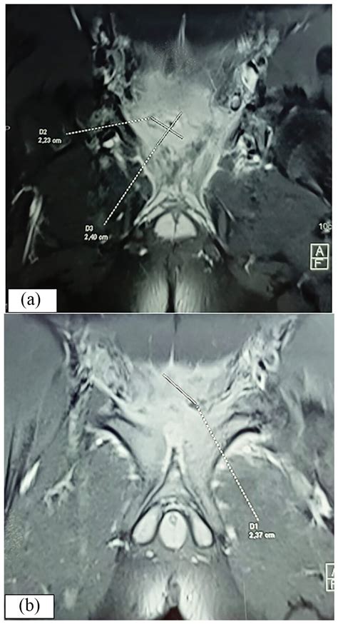 Pubic Symphysis Osteomyelitis Associated With Costal Osteitis Caused By