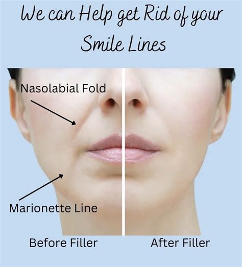 nasolabial filler