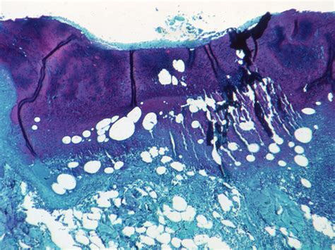 Monkeypox Is Not A Gay Virus Haven T We Been Here Before New Statesman