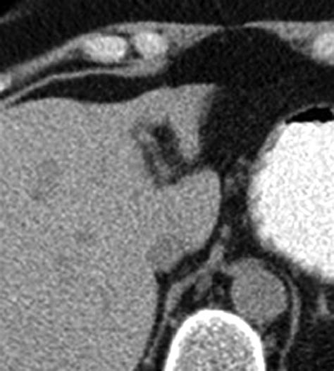 Radiofrequency Ablation In The Management Of Liver Metastases From