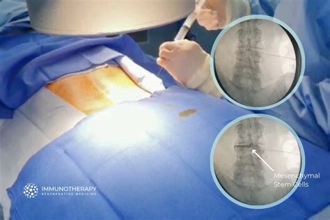 Stem Cell Therapy For Back Pain In Mexico Regenerative Medicine