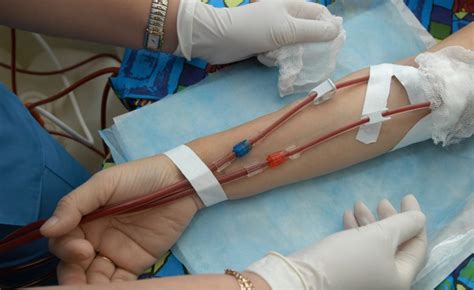 In Clinic Dialysis For An Effective And Best In Class Treatment