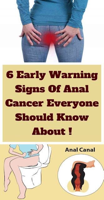 6 Early Warning Signs Of Anal Cancer Everyone Is Too Embarrassed To