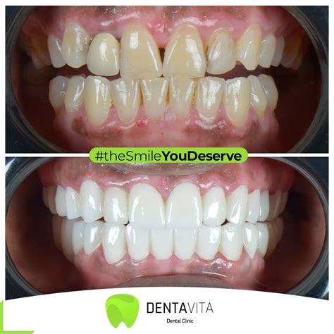 Porcelain Veneers Turkey Cost Beforeandafter Reviews Istanbul